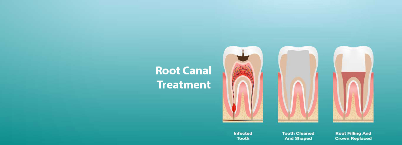 Root Canal Therapy