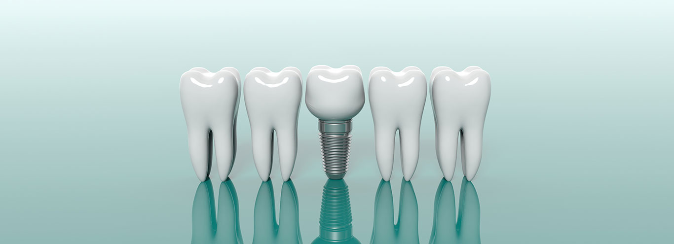 Dental Implants